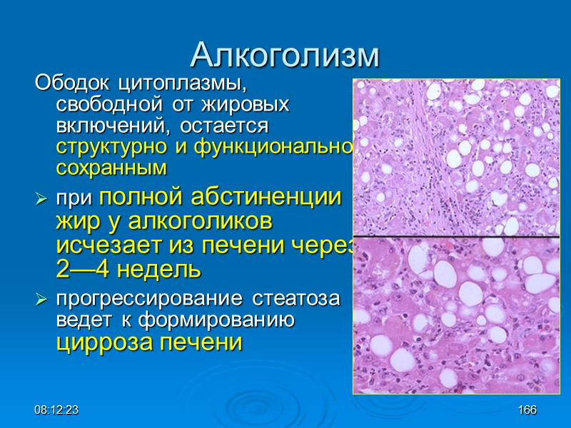 08:12:02 Алкоголизм Ободок цитоплазмы, свободной от жировых включений, остается структурно и функционально сохранным при